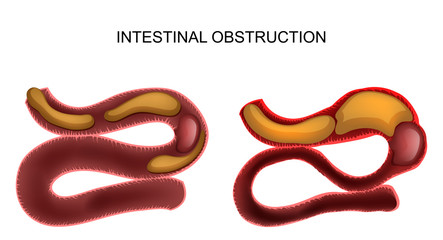 intestinal obstruction.abdominal surgery - obrazy, fototapety, plakaty