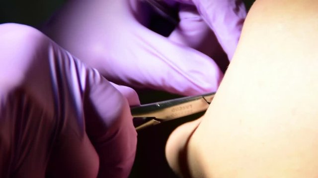 dental hands in purple gloves repairs the patient's teeth