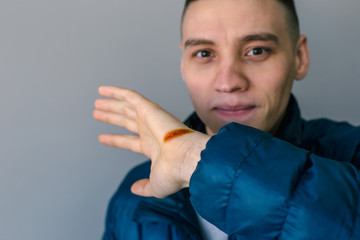 Man with injured hand and open cut, iodine-treated