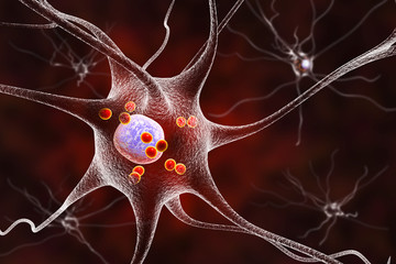 Parkinson's disease. 3D illustration showing neurons containing Lewy bodies small red spheres which are deposits of proteins accumulated in brain cells that cause their progressive degeneration