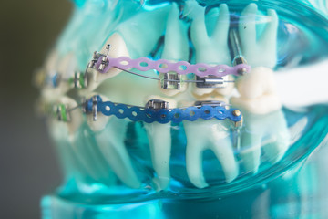 Dental teeth metal brackets