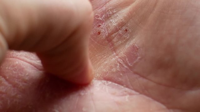 The man scratches his hands. Very itchy fingers, psoriasis.