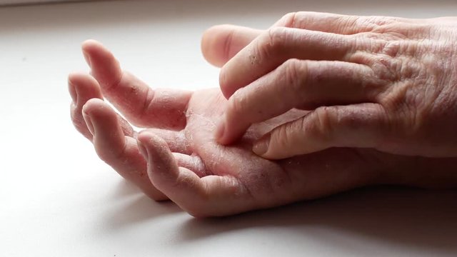 The man scratches his hands. Very itchy fingers, psoriasis.