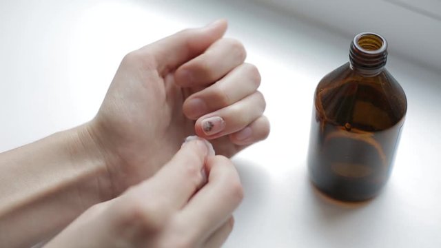 Trauma of handnail. Subungual hematoma. Injury to the sick nail. Girl disinfects the damaged nail plate with cotton wool and medical alcohol. The process of providing self-care.