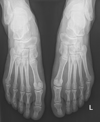 female feet xray radiograph