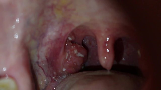 angina, purulent tonsillitis, throat with pus on tonsils
