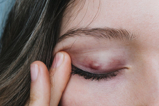 young girl shows a chalazion on the eyelid closeup