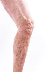 Fototapeta na wymiar People with varicose veins of the lower extremities and venous thrombophlebitis and standing on a white background
