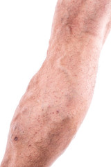 People with varicose veins of the lower extremities and venous thrombophlebitis and standing on a white background
