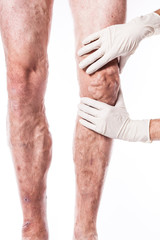 Doctor in medical gloves examines a person with varicose veins of the lower extremities and venous thrombophlebitis and on a white background