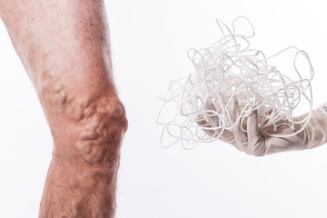 a tangle of ropes with a man being ill with varicose veins of the lower extremities and venous thrombophlebitis and on a white background, with depth of field Photo