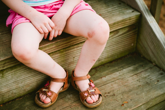 young girl with skinned knees sitting on steps