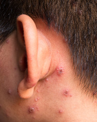 Chicken pox rash