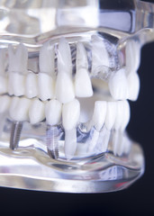 Fototapeta na wymiar Dentsts dental teeth model