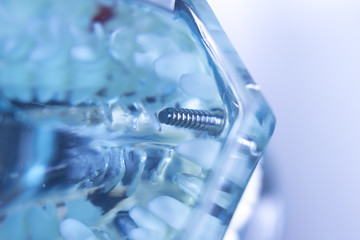 Dentsts dental tooth implant