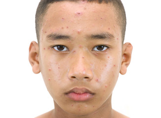 Chickenpox bubble rash on a boy.