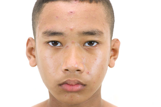 Chickenpox bubble rash on a boy.