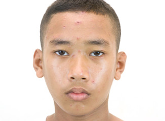 Chickenpox bubble rash on a boy.