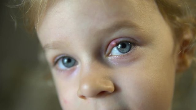inflammation of the eye