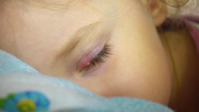 inflammation of the eye
