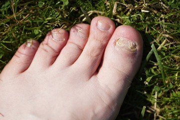 Onychomycosis. Fungal infection of nails of young man's feet