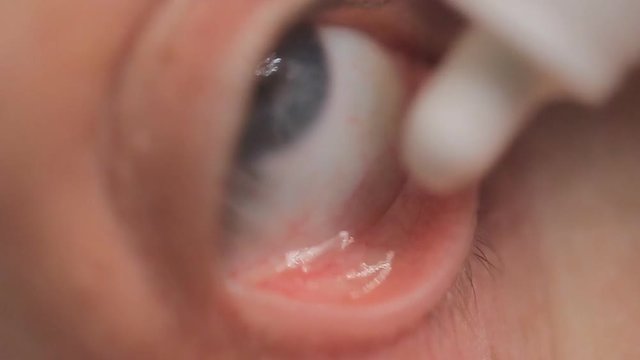 a young woman dripping medicinal drops in her eyes. close-up