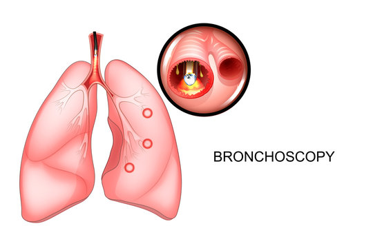 bronchoscopy of the lungs, sectional view