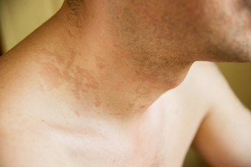 dermatitis skin