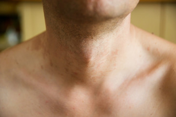 Fototapeta premium dermatitis skin