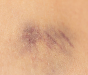 Fototapeta premium bruise on the skin