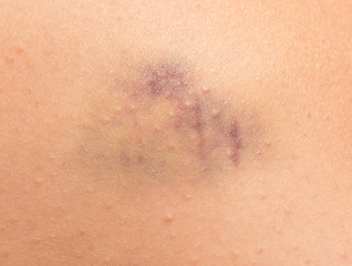 Fototapeta premium bruise on the skin
