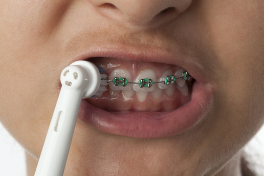 Teenage girl is brushing her teeth with dental braces