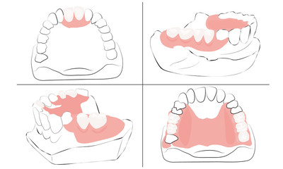 four variants of partial denture