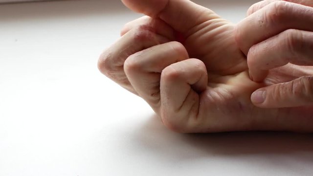 The man scratches his hands. Very itchy fingers, psoriasis.