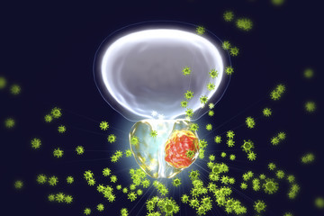 Conceptual image for viral ethiology of prostate cancer. 3D illustration showing viruses infecting prostate gland which develops cancerous tumor - obrazy, fototapety, plakaty