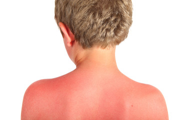 Naklejka premium Sunburn on a child's back