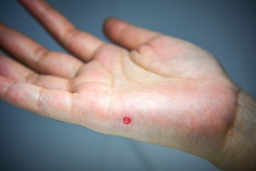 Blood Blister forming on the side of the hand