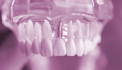 Fototapeta na wymiar Dental teeth mouth model