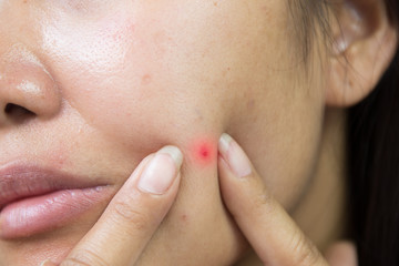 Naklejka premium Close up photo of acne prone skin, Asian woman squeezing her pimple, Removing pimple from face. Acne pus.