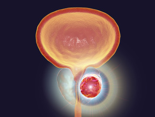 Conceptual image for prostate cancer treatment, 3D illustration showing destruction of a tumor inside prostate gland