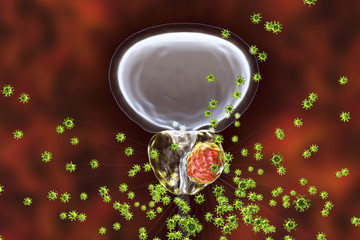Conceptual image for viral ethiology of prostate cancer. 3D illustration showing viruses infecting prostate gland which develops cancerous tumor
