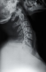 X-Ray of the Neck
