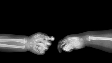 Baby 's hands x-ray and blank area at upper side . ( Shake hands ) . Isolated