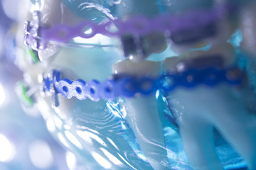 Dental teeth metal brackets