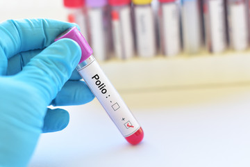 Blood sample positive with polio virus - obrazy, fototapety, plakaty
