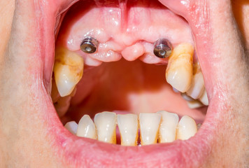 Canine dental implants in the mouth of a patient with advanced periodontitis