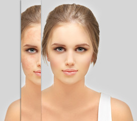Post-Acne Marks /Treating Acne Scars