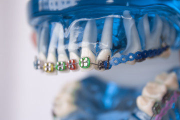 Classic dental metal orthodontics with colored hooks