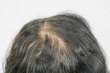 thin hair in old  women