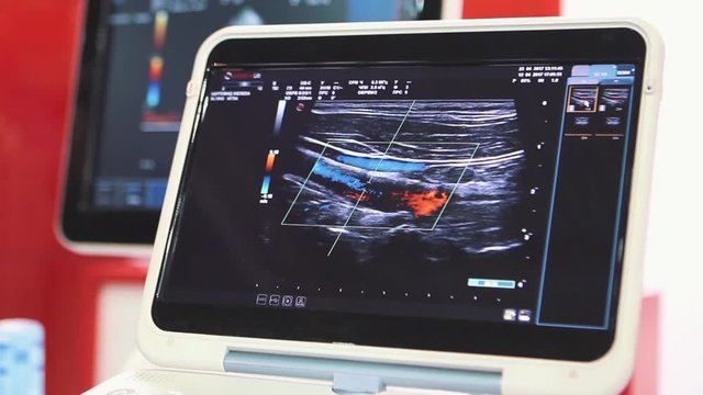Ultrasound machine with monitor